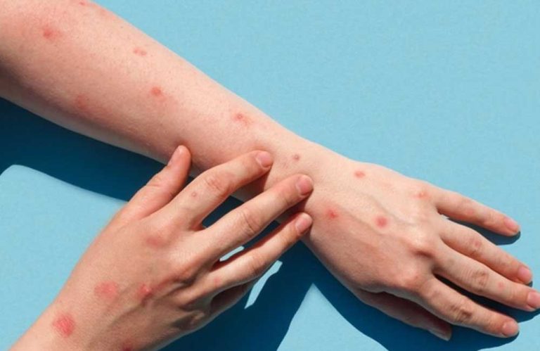 Rekomendasi Vaksin Campak untuk Dewasa