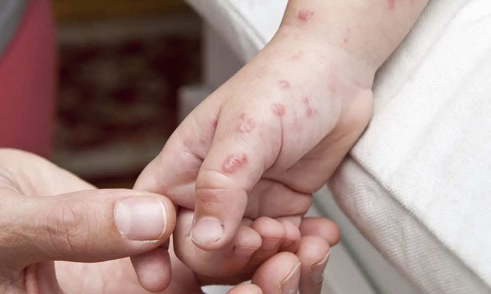 Read more about the article Herpes Zoster atau Cacar Api, Kenali Penyebab dan Cara Mengatasinya